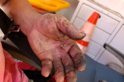 Terribles QUEMADURAS recibió un HOMBRE al sufrir una descarga ELECTRICA